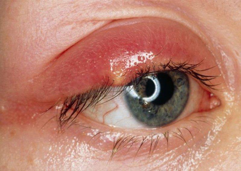 Learn About The Ayurvedic Treatment For A Seasonal Eye Inflammation Stye