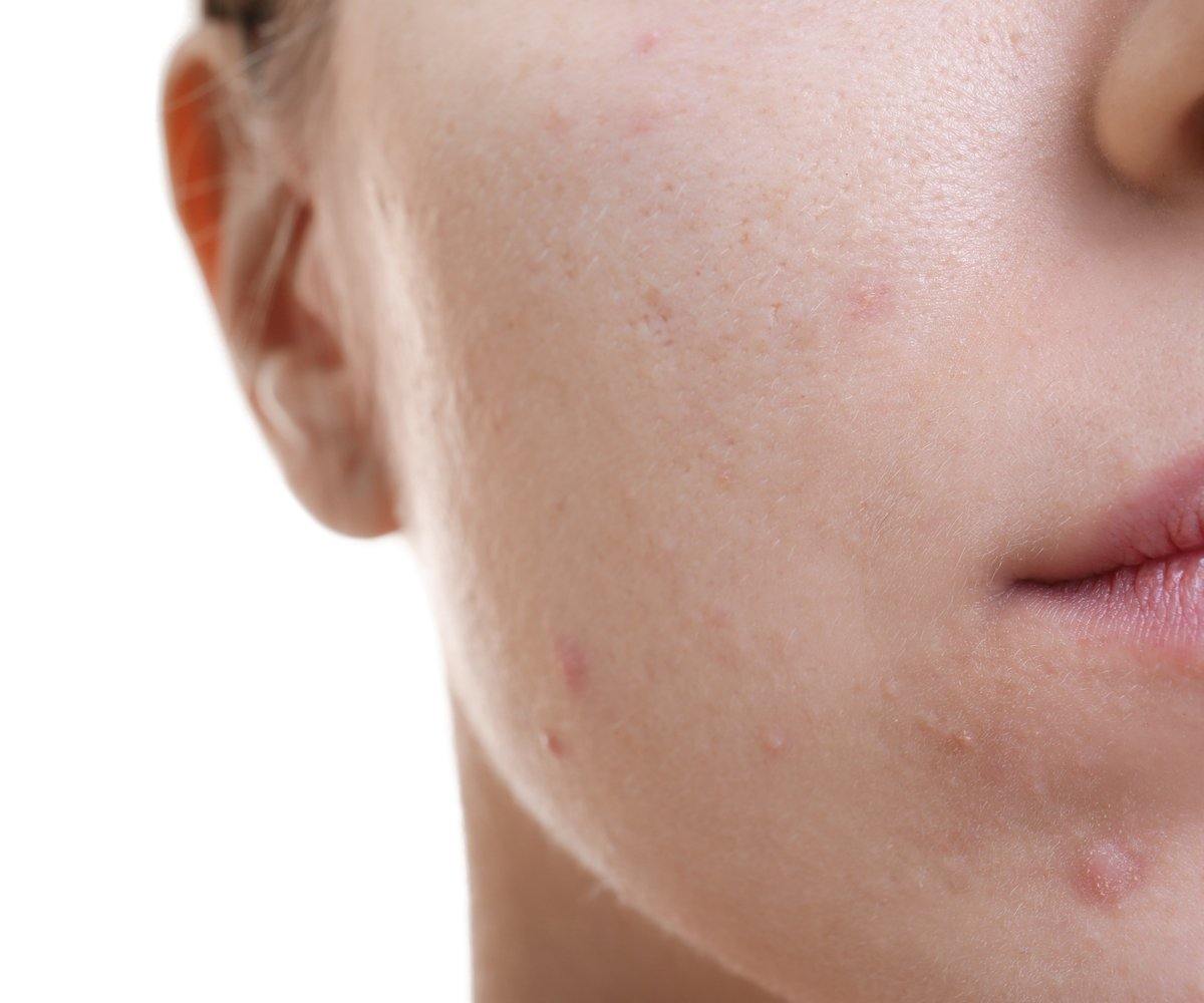 Are Pimples Ruining Your Beautiful Face – The Best Ayurvedic Remedies