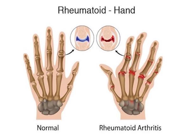 Ayurvedic Treatment Of Rheumatoid Arthritis - Treating This Disease Naturally