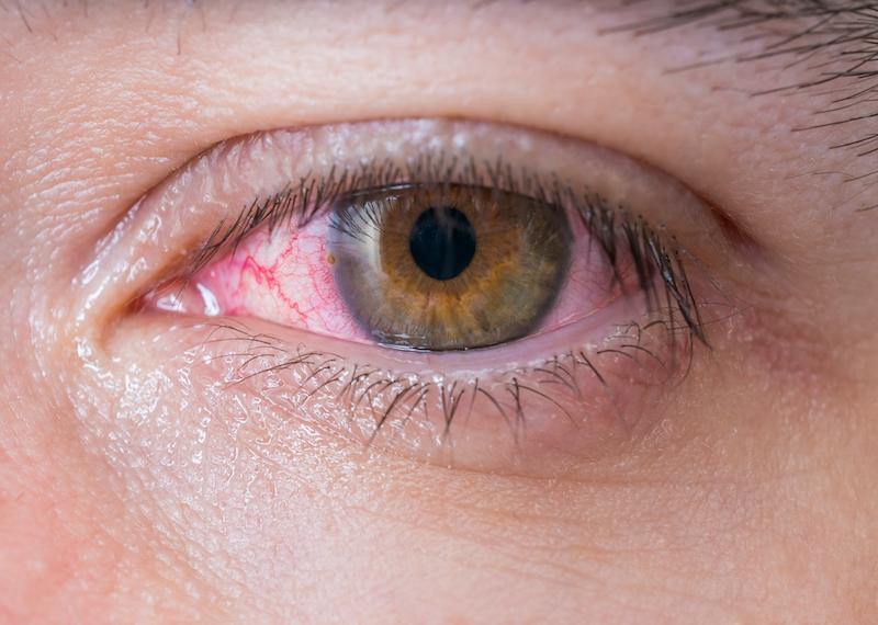 Eliminate Conjunctivitis with These Effective Natural Remedies Suggested By Ayurveda